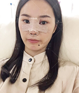 李火火隆鼻整形手术+北京美莱隆鼻案例