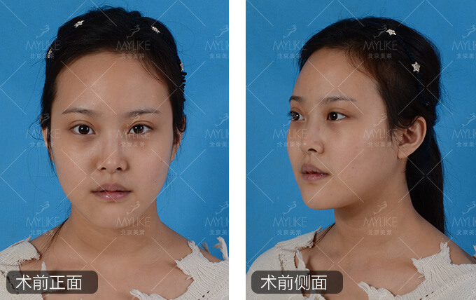 TianYY综合隆鼻手术+北京美莱鼻部案例