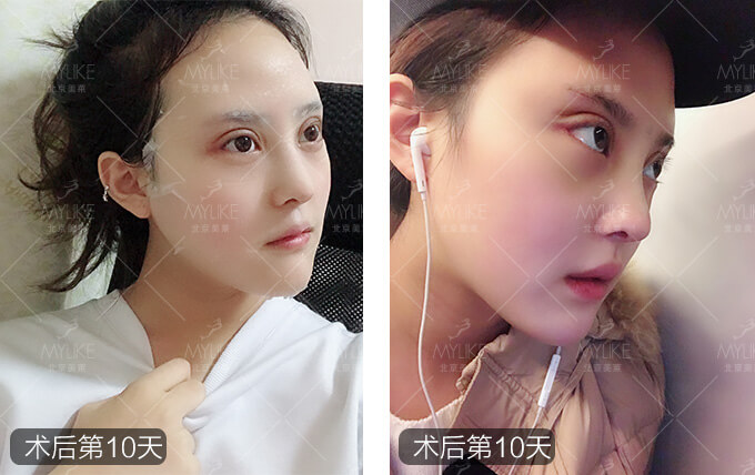 综合隆鼻手术+北京美莱鼻部案例