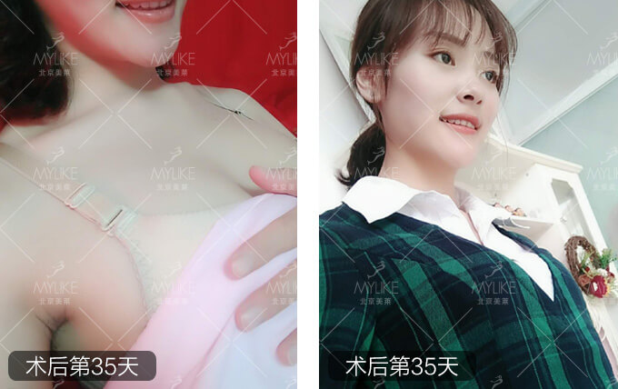 雨后蔷薇恋综合美胸整形+北京美莱胸部案例