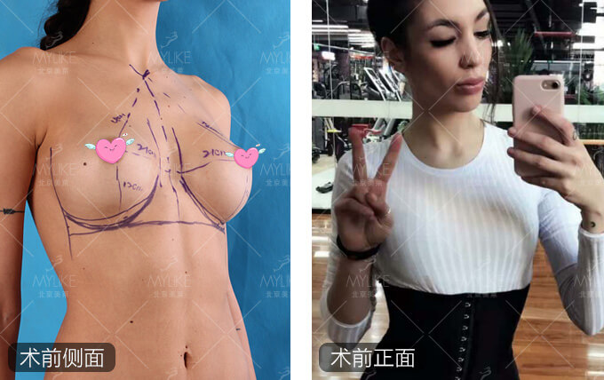 熊猫美眉动感丰胸整形+北京美莱胸部案例