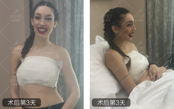 熊猫美眉动感丰胸整形+北京美莱胸部案例