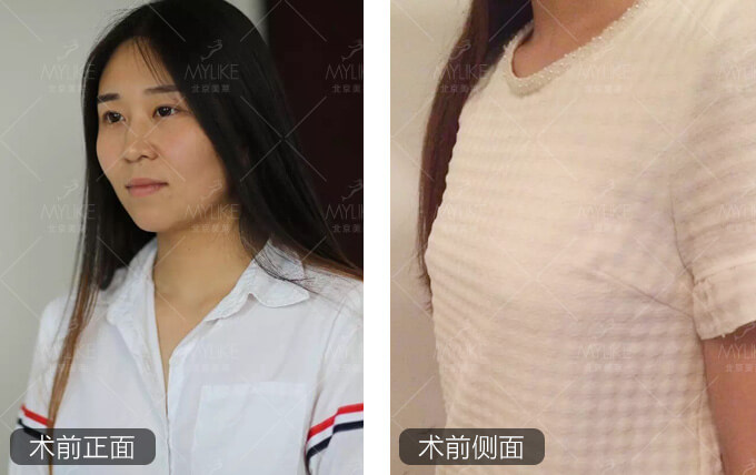 朵朵自体脂肪隆胸整形+北京美莱胸部案例