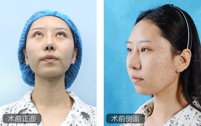 吕思佳光纤吸脂手术+北京美莱吸脂减肥案例