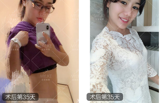 linda腰腹环吸吸脂减肥+北京美莱吸脂案例