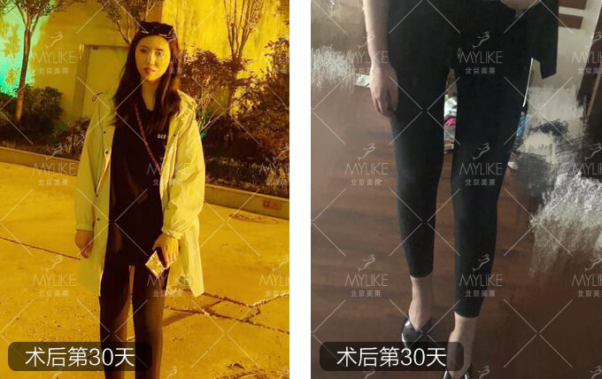 小岳岳呀大腿抽脂减肥+北京美莱吸脂瘦腿案例