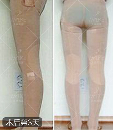 张梦腿部吸脂减肥+北京美莱吸脂瘦腿案例