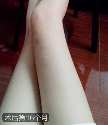 张梦腿部吸脂减肥+北京美莱吸脂瘦腿案例