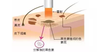 美莱激光祛斑的效果可以保持多久