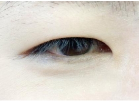 双眼皮有哪几种类型，哪种效果好