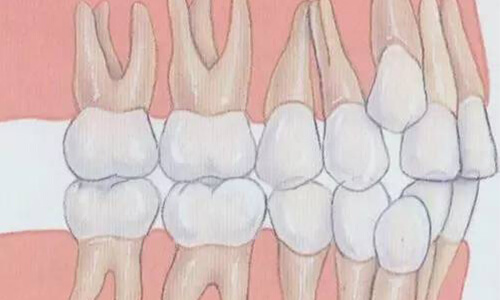 牙齿矫正可以只矫正几个吗
