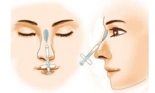 注射隆鼻怎么才能避免鼻部变宽