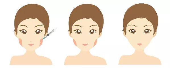 吸脂瘦脸和注射瘦脸哪个瘦脸效果更好