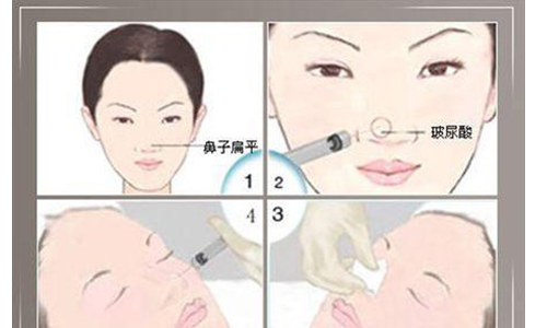 上海注射玻尿酸隆鼻到底有什么优势