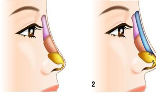 隆鼻整形材料有三种，选择哪家隆鼻效果比较好
