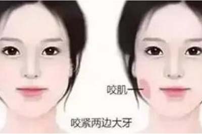 上海注射瘦脸大概需要多少钱