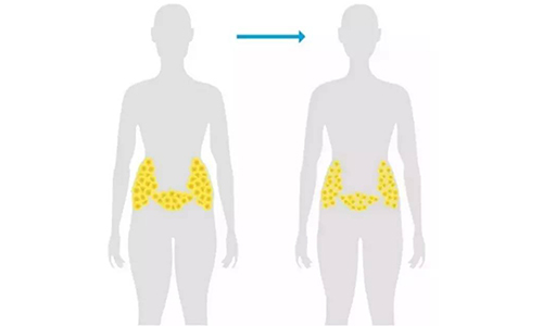 上海做腰腹部吸脂手术会不会留疤