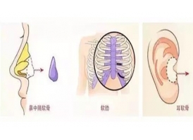 上海软骨隆鼻和硅胶隆鼻哪个效果好