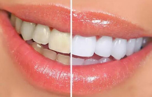 牙齿冷光美白的特点都有哪些呢，哪些人适合做