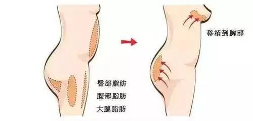上海做自体脂肪隆胸会不会留下疤痕
