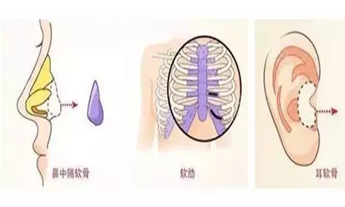 上海做自体软骨隆鼻手术有哪些优势