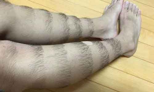 激光脱腿毛有副作用吗，上海哪家脱毛安全呢