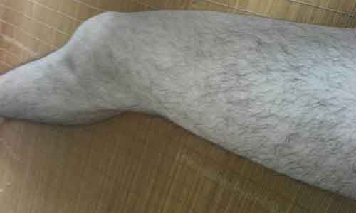 激光脱腿毛有副作用吗，上海哪家脱毛安全呢