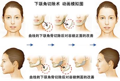 上海做脸部角整形手术要多少钱