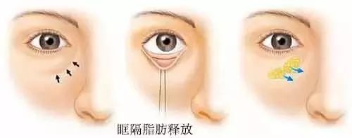 上海美莱科普|眼袋类型及治疗方法具体趋势