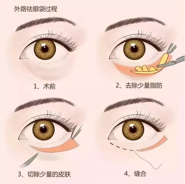 上海美莱科普|眼袋类型及治疗方法具体趋势