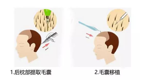 上海做头发种植效果怎么样？