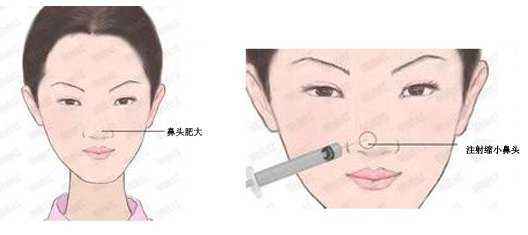 上海鼻头缩小术能维持多久,会不会出现反弹现象？