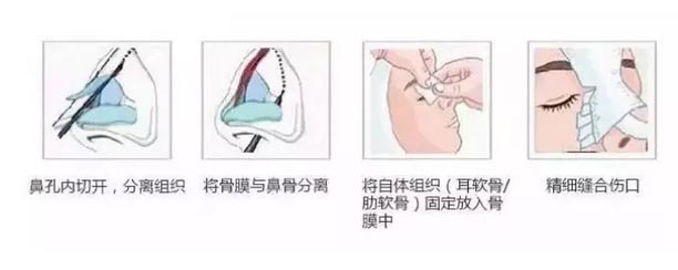 耳软骨隆鼻术医院上海美莱做的可以吗