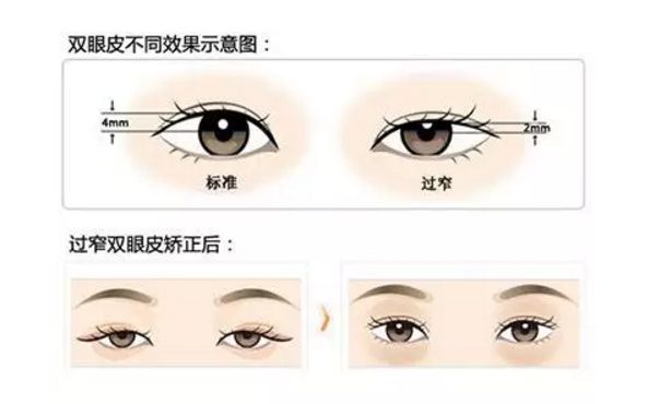 上海好的双眼皮修复医院双眼皮修复多少钱？