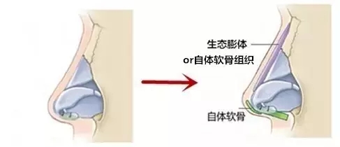 异体肋软骨隆鼻可以用在鼻综合里吗