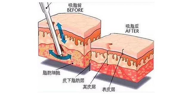 较好吸脂，上海美莱急速*雕吸脂术瘦身一生...