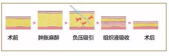 较好吸脂，上海美莱急速*雕吸脂术瘦身一生...