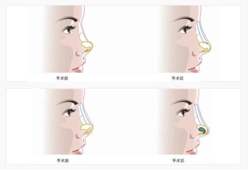 上海美莱做鼻尖整形可以改善的好蒜头鼻吗？
