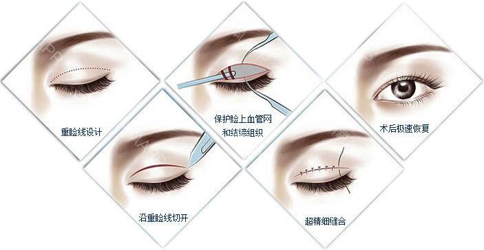 上海割双眼皮方法，全切双眼皮要多久定型