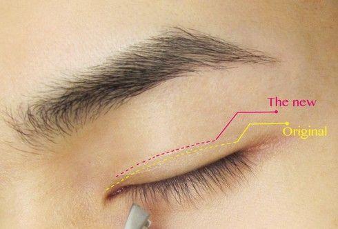 上海的双眼皮医院疤痕体质可以做全切双眼皮吗
