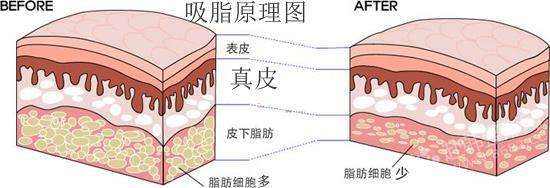 上海多维立体吸脂的“过程”是什么样子?