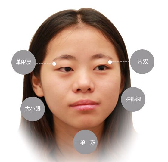 上海美莱四种尤为标准双眼皮，你GET哪种？