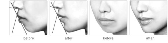 哪些类型下巴需要整形？有效的方法有哪些？