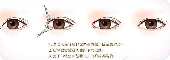<a href='/' target='_blank'><u>上海美莱</u></a>做开眼角内眼角手术多少钱