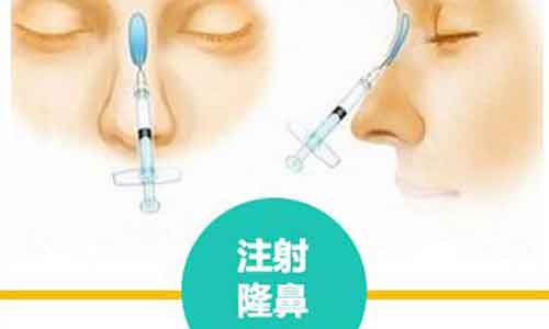玻尿酸垫鼻子多少钱,上海医院贵不贵?