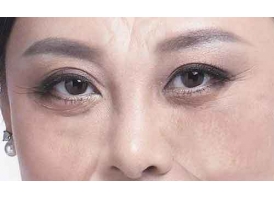 美莱韩式不易留疤痕去眼袋“副作用”有吗?