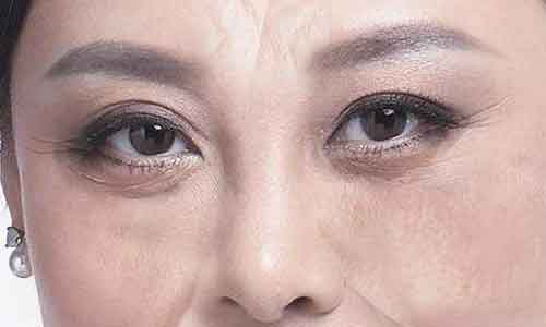 美莱韩式不易留疤痕去眼袋“副作用”有吗?
