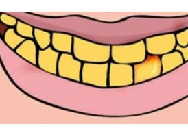 牙齿不白的原因有哪些、有“好的”美白方法吗?