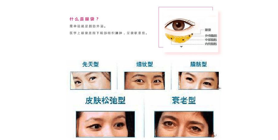 上海祛眼袋医院做祛眼袋手术后几天能恢复