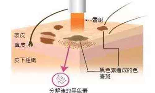 磨皮界的神器—蜂巢皮秒!美莱蜂巢皮秒5大优势